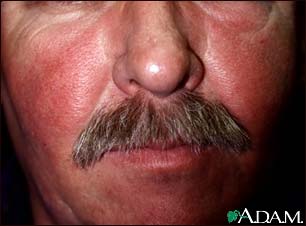 Systemic lupus erythematosus rash on the face Systemic lupus erythematosus rash on the face