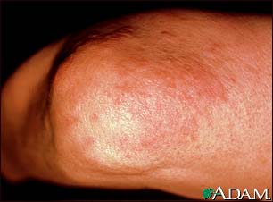 Granuloma, annulare on the elbow Granuloma, annulare on the elbow