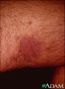 Kaposi's sarcoma on the thigh Kaposi's sarcoma on the thigh