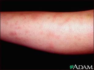 Erythema nodosum associated with sarcoidosis Erythema nodosum associated with sarcoidosis