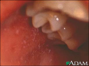 Measles, Koplik spots - close-up