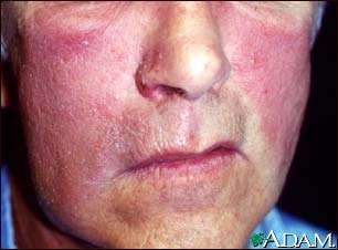 Erysipelas on the face Erysipelas on the face