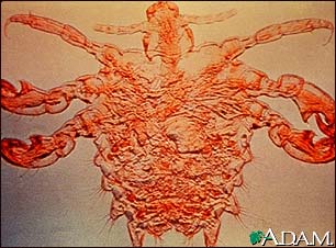 Pubic louse-male Pubic louse-male