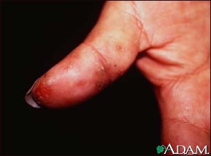 Dermatitis, herpetiformis on the thumb Dermatitis, herpetiformis on the thumb