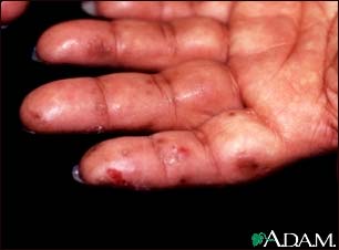 Dermatitis, herpetiformis on the hand Dermatitis, herpetiformis on the hand