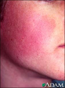 Keratosis pilaris rubra faceii