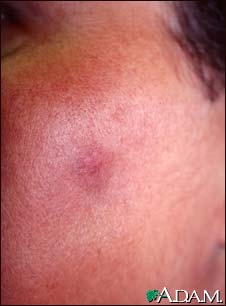 Fixed drug eruption on the cheek Fixed drug eruption on the cheek