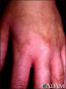 Phytophotodermatitis on the hand Phytophotodermatitis on the hand