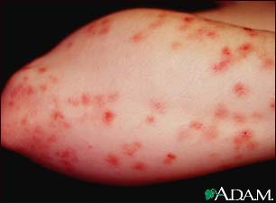 Dermatitis, herpetiformis on the forearm Dermatitis, herpetiformis on the forearm