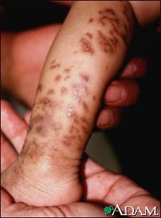 Incontinentia pigmenti on the leg Incontinentia pigmenti on the leg