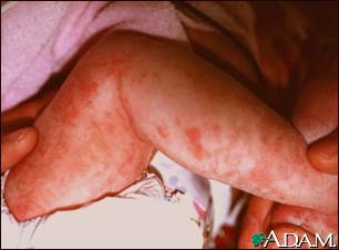 Incontinentia pigmenti on the leg Incontinentia pigmenti on the leg