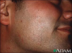 Molluscum contagiosum on the face Molluscum contagiosum on the face