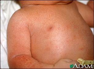 Miliaria crystallina - chest and arm Miliaria crystallina - chest and arm