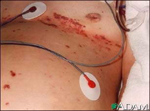 Herpes zoster (shingles), disseminated Herpes zoster (shingles), disseminated