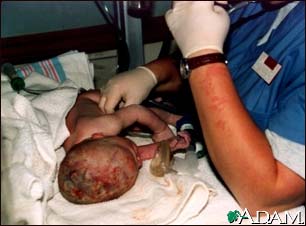 Infant care following delivery Infant care following delivery