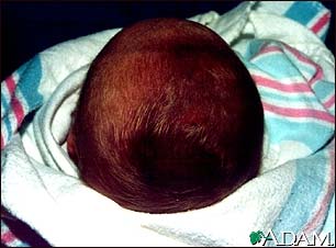 Caput succedaneum Caput succedaneum