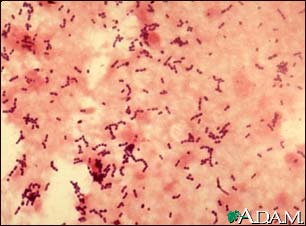 Pneumococcal pneumonia Pneumococcal pneumonia