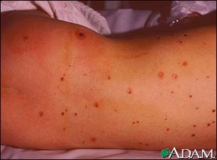 Meningococcal lesions on the back Meningococcal lesions on the back