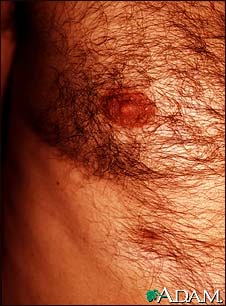 Supernumerary nipple Supernumerary nipple