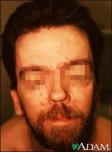 Basal cell nevus syndrome - face Basal cell nevus syndrome - face