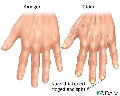 Aging changes in nails Aging changes in nails