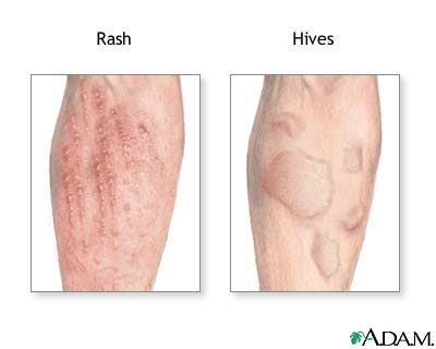 Allergic reactions Allergic reactions