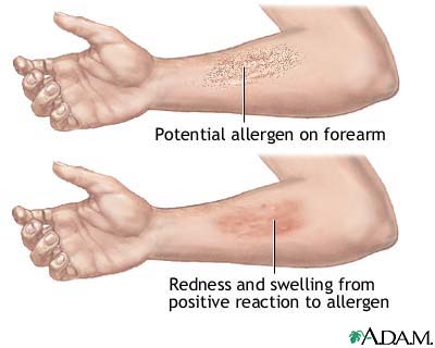 Positive reaction to allergen Positive reaction to allergen
