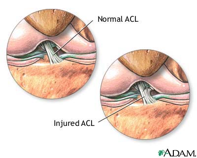 Anterior cruciate ligament (ACL) injury
