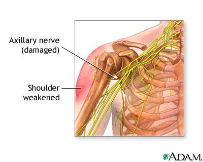 Damaged axillary nerve