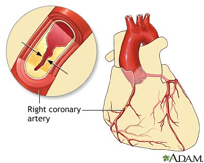 Coronary artery disease Coronary artery disease