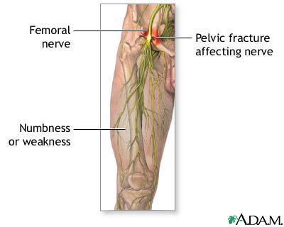 Femoral nerve damage Femoral nerve damage