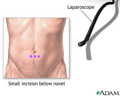 Incision for abdominal laparoscopy Incision for abdominal laparoscopy