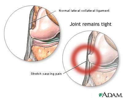 Lateral collateral ligament pain Lateral collateral ligament pain