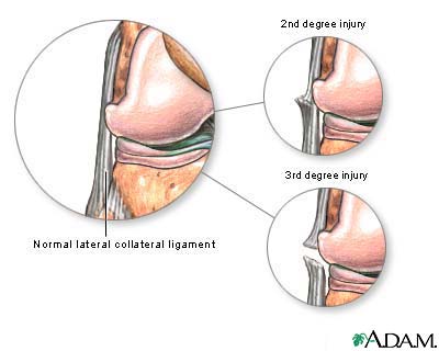 Lateral collateral ligament injury Lateral collateral ligament injury