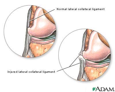 Torn lateral collateral ligament Torn lateral collateral ligament