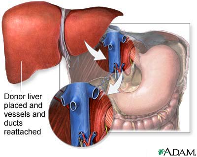 Donor liver attachment Donor liver attachment