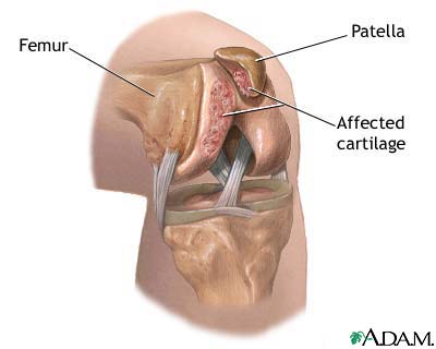 Chondromalacia of the patella Chondromalacia of the patella