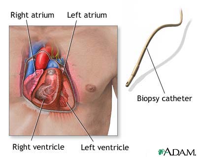 Biopsy catheter Biopsy catheter