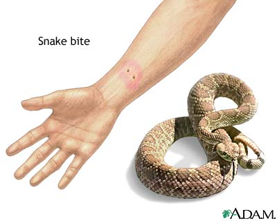 Snake bite Snake bite