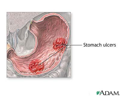 Stomach disease or trauma Stomach disease or trauma