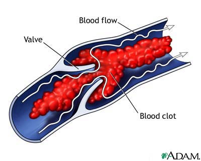 Venous blood clot Venous blood clot