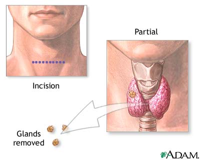 Parathyroidectomy Parathyroidectomy