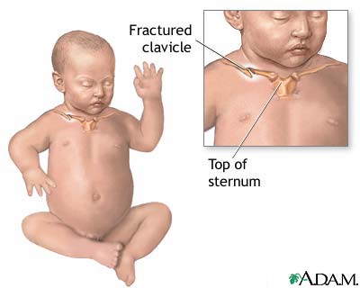 Fractured clavicle (infant) Fractured clavicle (infant)