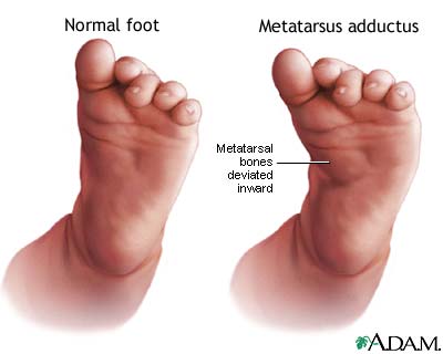 Metatarsus adductus Metatarsus adductus