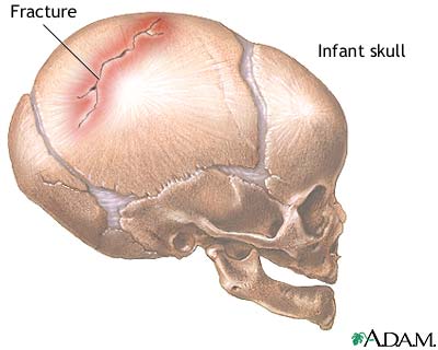 Infant skull fracture Infant skull fracture