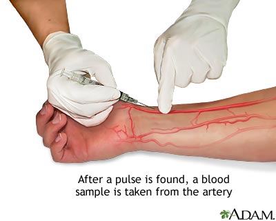Arterial blood sample Arterial blood sample