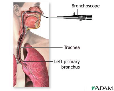 Bronchoscopy Bronchoscopy