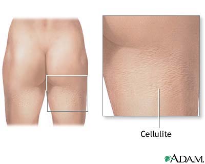 Cellulite Cellulite