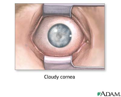 Cloudy cornea Cloudy cornea