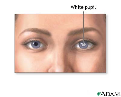 White pupil White pupil